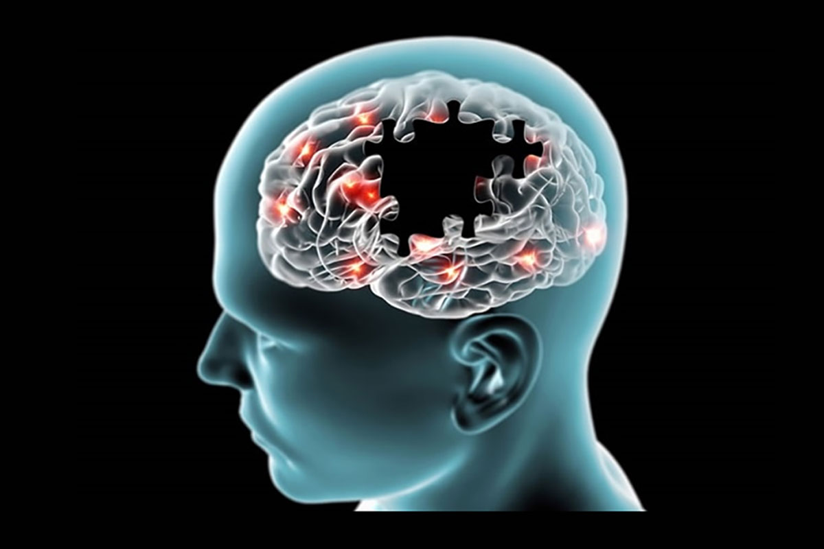alzheimers 102820
