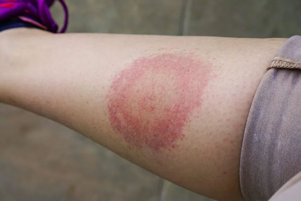 lymedisease 081123